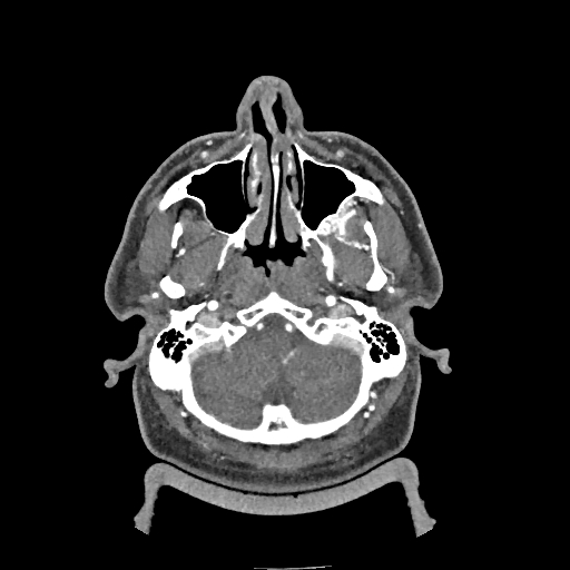 Buccal fat pad arteriovenous malformation (Radiopaedia 70936-81144 D 236).jpg