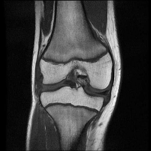 File:Bucket handle tear - lateral meniscus (Radiopaedia 72124-82634 Coronal T1 10).jpg