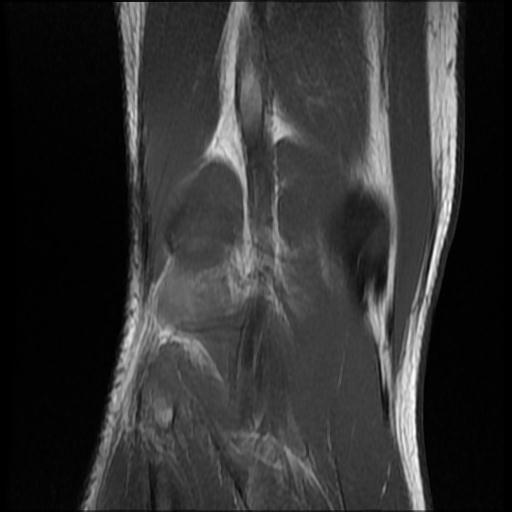 File:Bucket handle tear - medial meniscus (Radiopaedia 69245-79026 Coronal T1 18).jpg