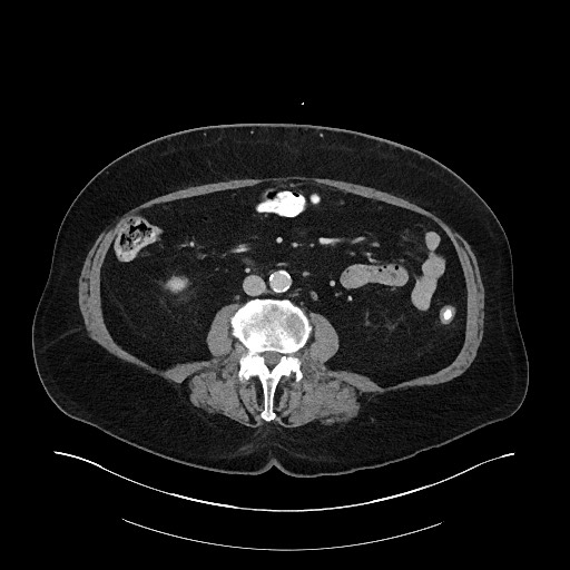File:Buried bumper syndrome - gastrostomy tube (Radiopaedia 63843-72575 Axial 34).jpg