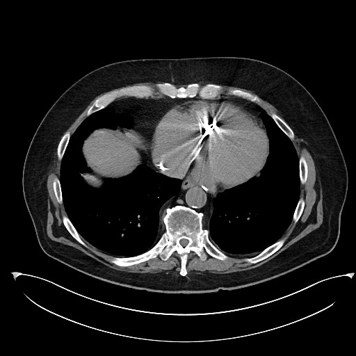 File:Buried bumper syndrome - gastrostomy tube (Radiopaedia 63843-72577 Axial Inject 3).jpg