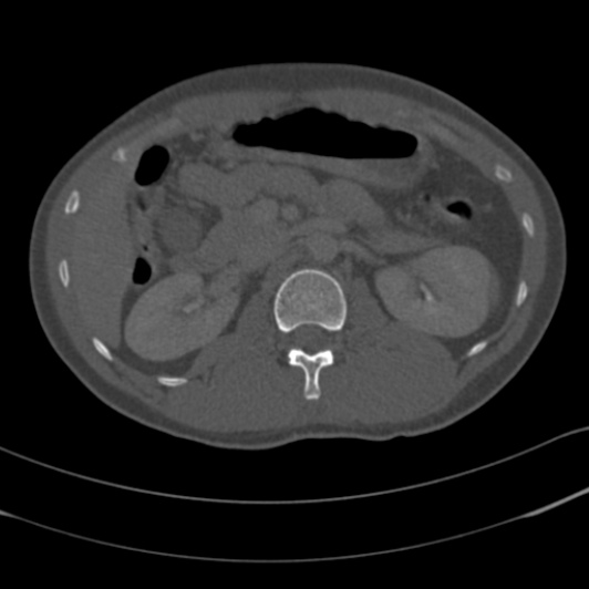 Burst fracture with cauda equina syndrome (Radiopaedia 25701-25867 Axial bone window 9).jpg