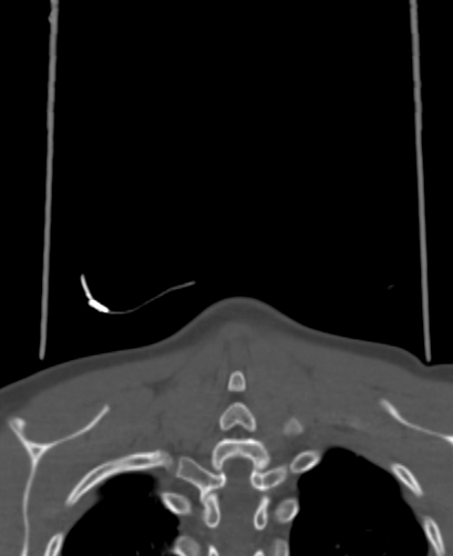 Butterfly vertebra (Radiopaedia 77903-90209 Coronal bone window 104).jpg