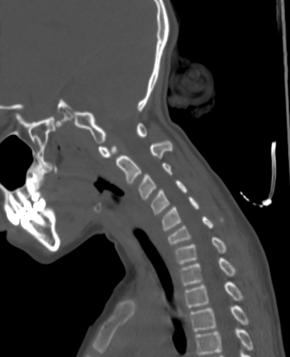 Butterfly vertebra (Radiopaedia 77903-90209 Sagittal bone window 60).jpg