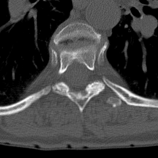 Butterfly vertebrae with kyphoscoliosis (Radiopaedia 14257-14133 Axial bone window 9).jpg