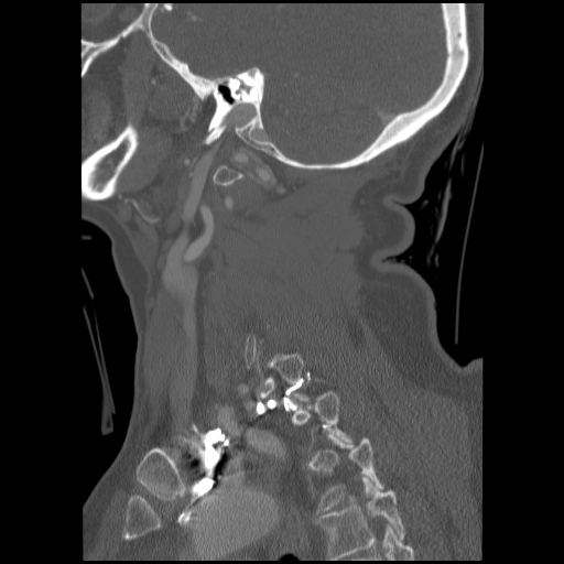 File:C1 anterior arch (plough) fracture - type 1 (Radiopaedia 76181-87720 Sagittal bone window 33).jpg