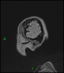 CNS manifestations of NF1 - optic pathway glioma, neurofibroma, dural ectasia (Radiopaedia 37874-39805 Sagittal FLAIR 15).jpg