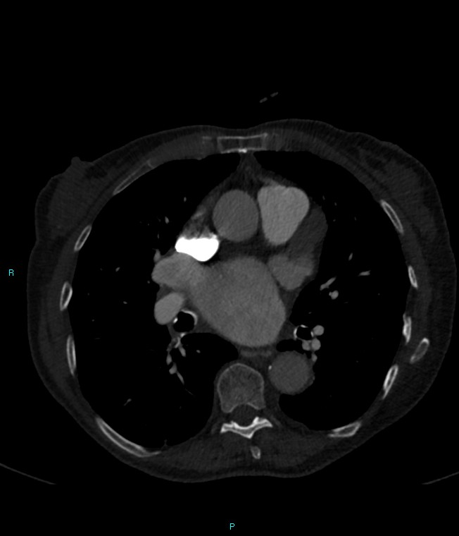 Calcified cerebral emboli from left ventricular thrombus (Radiopaedia 84420-99760 Axial bone window 43).jpg