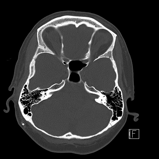 Calcified chronic subdural hematoma (Radiopaedia 77374-89492 Axial bone window 33).jpg