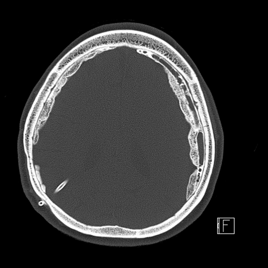 Calcified chronic subdural hematoma (Radiopaedia 77374-89492 Axial bone window 94).jpg