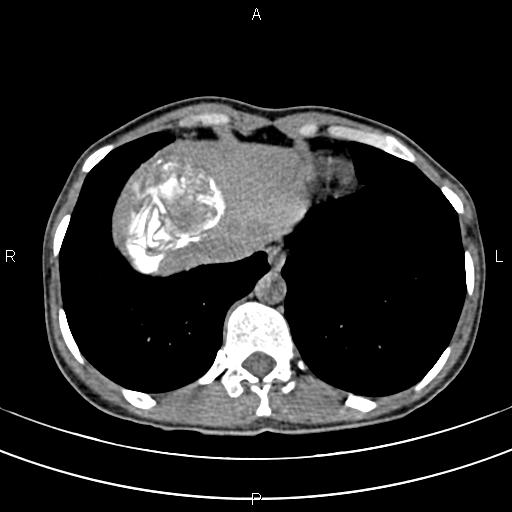 File:Calcified hepatic hydatid cyst (Radiopaedia 83870-99072 Axial non-contrast 16).jpg