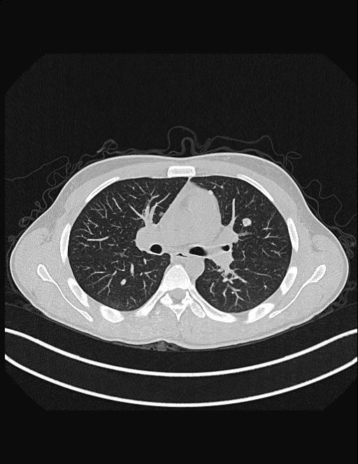 Calcifying pulmonary metastases (Radiopaedia 33359-34396 Axial lung window 27).jpg