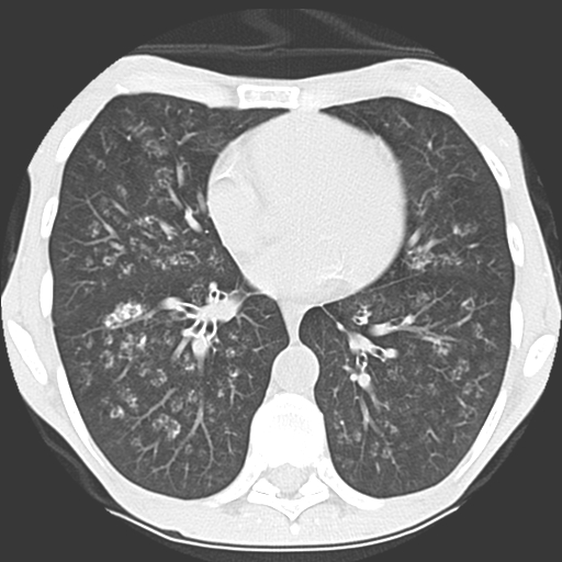 File:Calciphylaxis and metastatic pulmonary calcification (Radiopaedia 10887-11317 Axial lung window 27).jpg