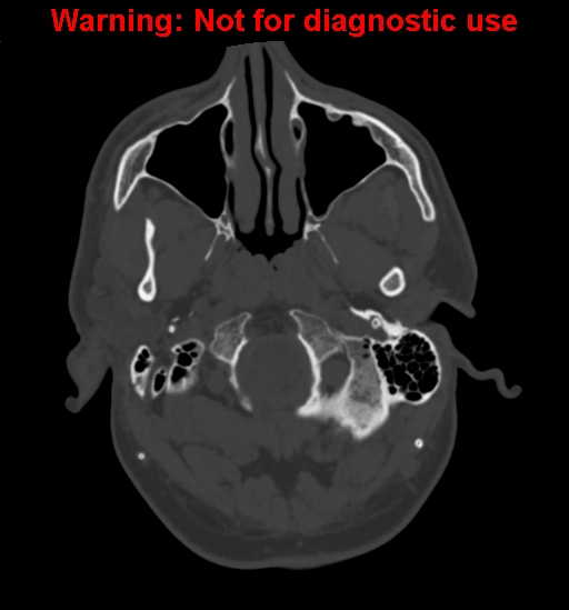 Calvarial thickening from chronic shunting (Radiopaedia 60079-67637 Axial bone window 12).jpg