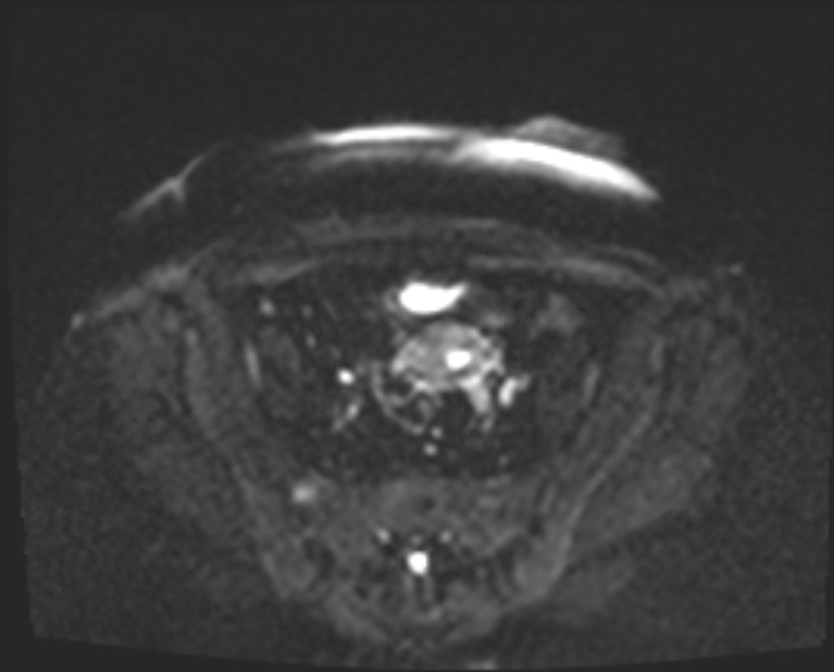 Cancer cervix - stage IIb (Radiopaedia 75411-86615 Axial DWI 23).jpg
