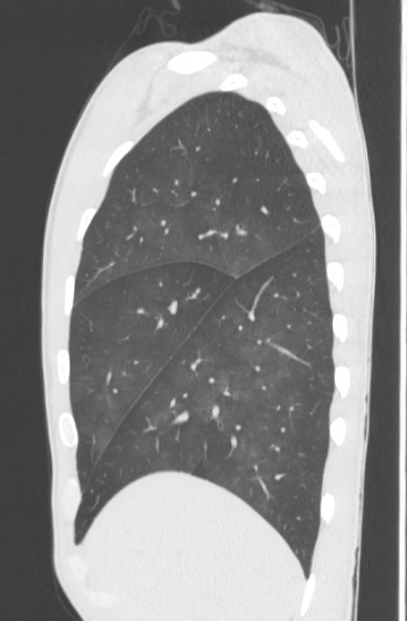 Cannabis-induced diffuse alveolar hemorrhage (Radiopaedia 89834-106946 Sagittal lung window 28).jpg