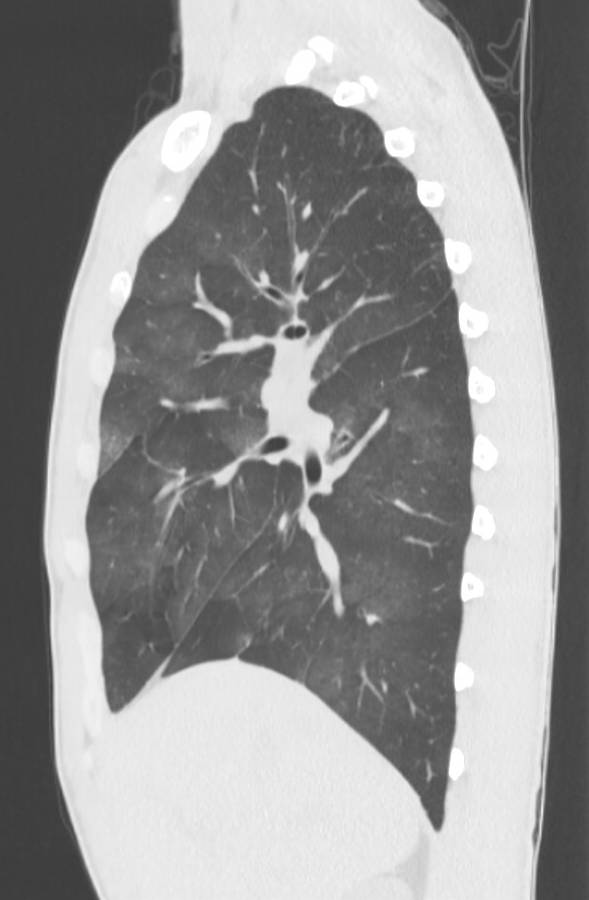 Cannabis-induced diffuse alveolar hemorrhage (Radiopaedia 89834-106946 Sagittal lung window 47).jpg