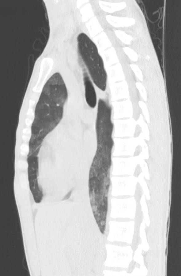 Cannabis-induced diffuse alveolar hemorrhage (Radiopaedia 89834-106946 Sagittal lung window 64).jpg