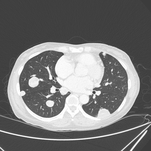File:Canonball lung metastasis (Radiopaedia 77634-89837 Axial lung window 100).jpg