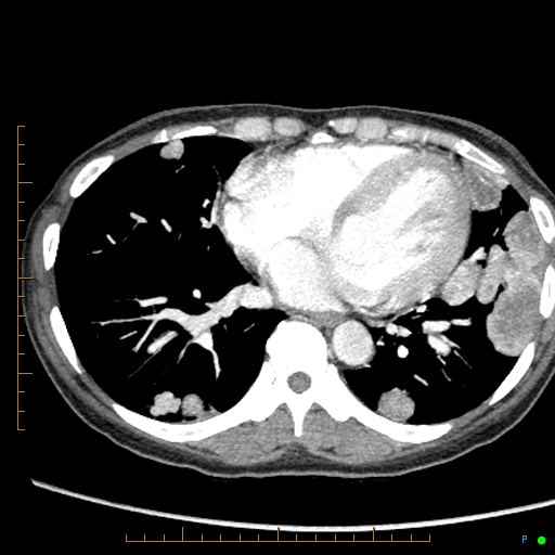 Canonball lung metastasis (Radiopaedia 77634-89837 B 66).jpg