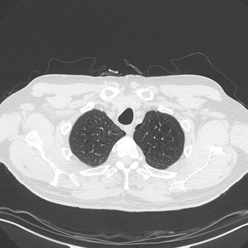 Caplan syndrome (Radiopaedia 56667-63530 Axial lung window 34).jpg