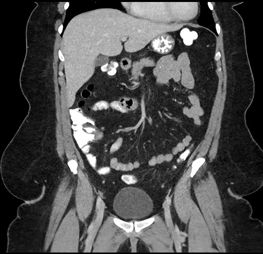Carcinoid tumor - terminal ileum (Radiopaedia 60931-68739 B 25).jpg