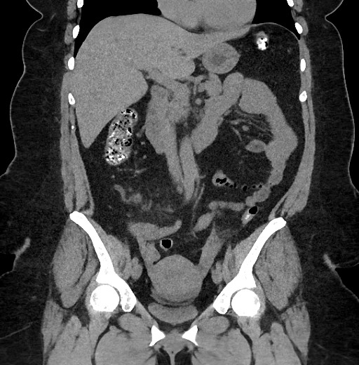 Carcinoid tumor - terminal ileum (Radiopaedia 60931-68740 Coronal non-contrast 46).jpg