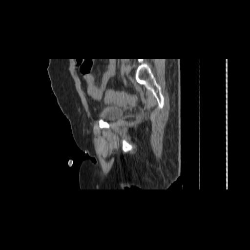 Carcinoma cervix- brachytherapy applicator (Radiopaedia 33135-34173 D 131).jpg