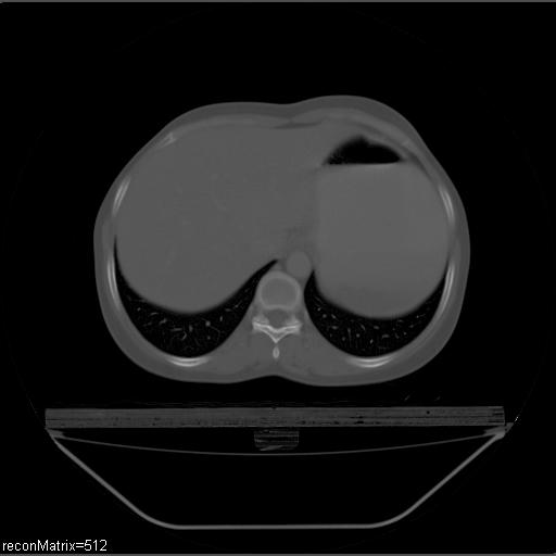 File:Carcinoma of esophagus (Radiopaedia 27356-27550 Axial bone window 7).jpg