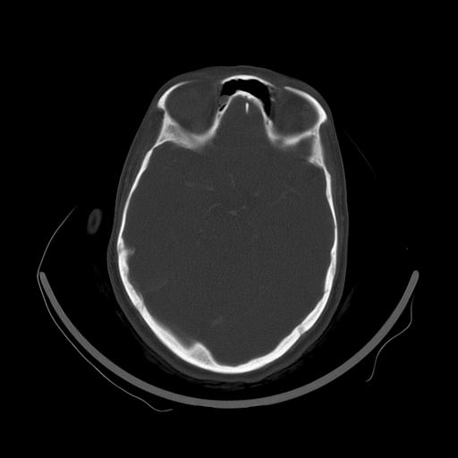 Carcinoma of the maxillary antrum (Radiopaedia 53805-59888 Axial bone window 9).jpg