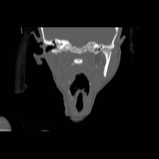 Carcinoma of the maxillary antrum (Radiopaedia 53805-59888 Coronal bone window 86).jpg
