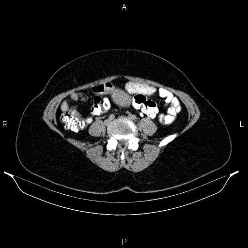 File:Carcinoma of uterine cervix (Radiopaedia 85861-101700 Axial C+ delayed 54).jpg