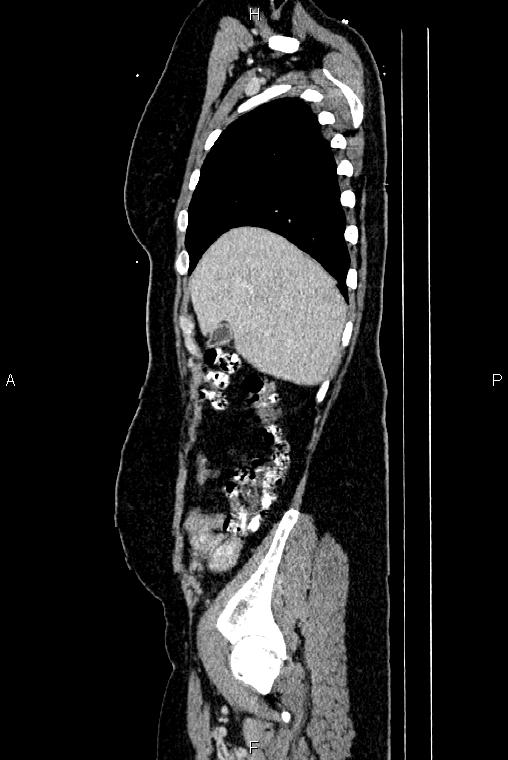 Carcinoma of uterine cervix (Radiopaedia 85861-101700 D 11).jpg