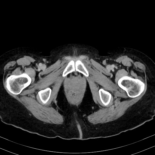 Carcinosarcoma (Radiopaedia 70401-80503 A 71).jpg