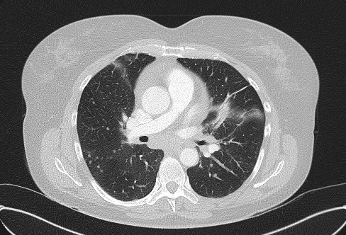 Cardiac sarcoidosis (Radiopaedia 74548-85534 Axial lung window 39).jpg