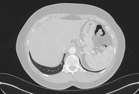 Cardiac sarcoidosis (Radiopaedia 74548-85534 Axial lung window 86).jpg