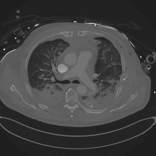 Cardiac trauma (Radiopaedia 32874-33858 Axial bone window 37).jpg