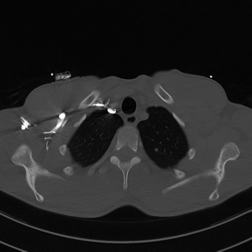 File:Cardiac tumor - undifferentiated pleomorphic sarcoma (Radiopaedia 45844-50134 Axial bone window 9).png