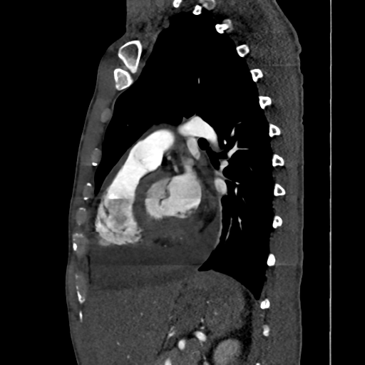 Cardiac tumor - undifferentiated pleomorphic sarcoma (Radiopaedia 45844-50134 B 28).png