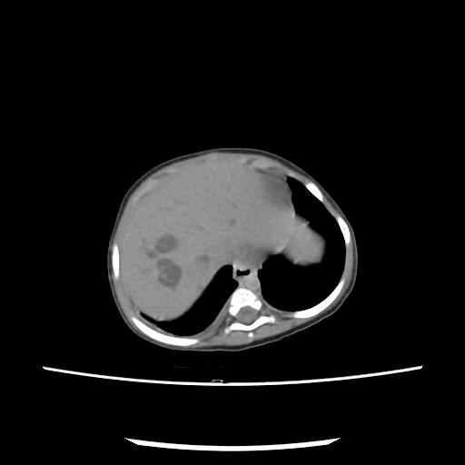 Caroli disease with autosomal recessive polycystic kidney disease (ARPKD) (Radiopaedia 89651-106703 E 23).jpg
