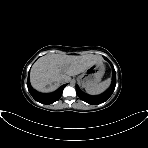 Caroli disease with medullary sponge kidney (Radiopaedia 82622-96804 Axial non-contrast 17).jpg