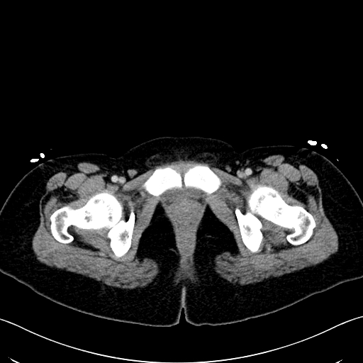 Caroli disease with medullary sponge kidney (Radiopaedia 82622-96804 C 77).jpg