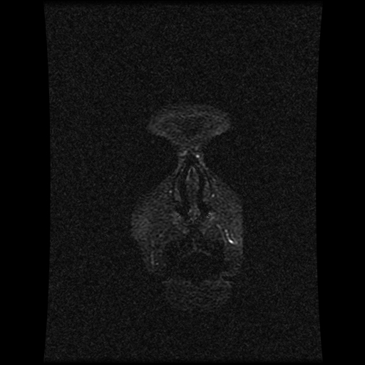 Carotid arterial dissection with acute cerebral infarction (Radiopaedia 26636-26784 MRV 157).jpg