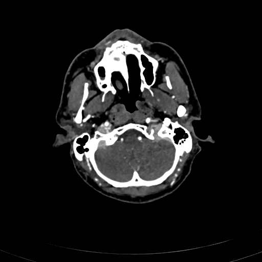 File:Carotid body tumor (Radiopaedia 83615-98727 A 27).jpg