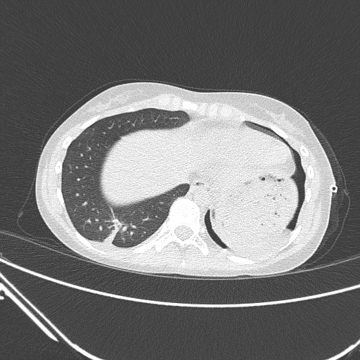 Catamenial pneumothorax (Radiopaedia 27946-28197 lung window 128).jpg