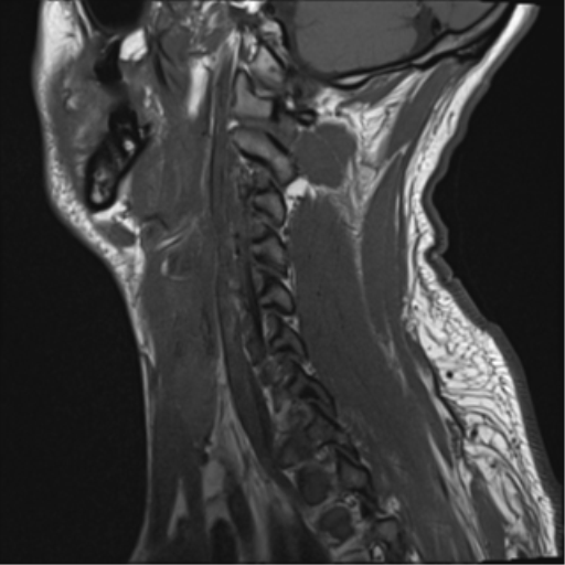 File:Cavernoma of cervical cord (Radiopaedia 50838-56347 Sagittal T1 3).png