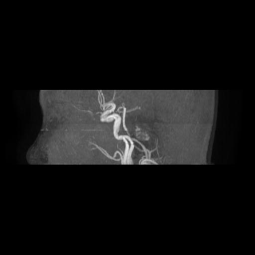 Cavernoma with developmental venous anomaly (Radiopaedia 22470-22507 MRA 1).jpg