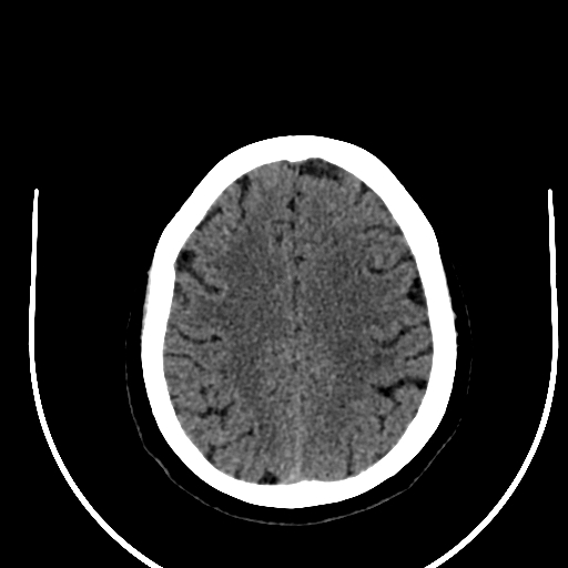 Cavernous hemangioma of the cerebellar falx (Radiopaedia 73025-83723 Axial non-contrast 100).jpg