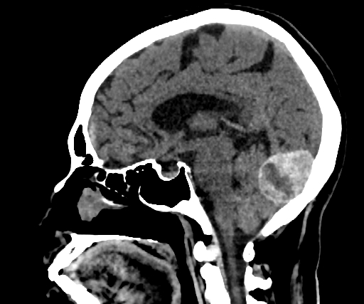Cavernous hemangioma of the cerebellar falx (Radiopaedia 73025-83723 B 173).jpg