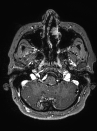 File:Cavernous hemangioma of the cerebellar falx (Radiopaedia 73025-83724 Axial T1 C+ 280).jpg